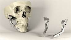 Orthopedic Implant