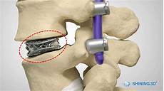 Spinal Implant