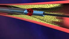 Medical Aspiration Devices