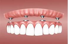 Medical Implant
