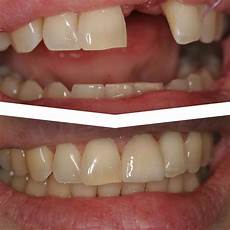Medical Implants