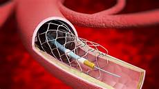 Medical Implants