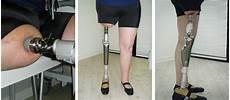 Medical Prostheses