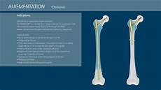 Medical Screw