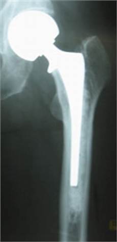 Medical Screw