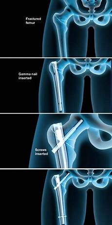 Medical Screw