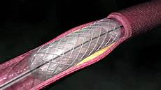 Medical Stent