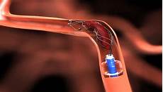 Medical Stent