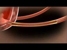 Medical Stent