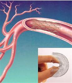 Medical Stent