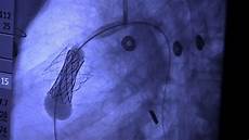 Medical Valves