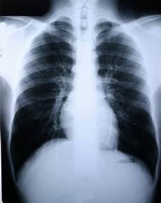 Medical X-Ray Films