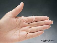 Splint